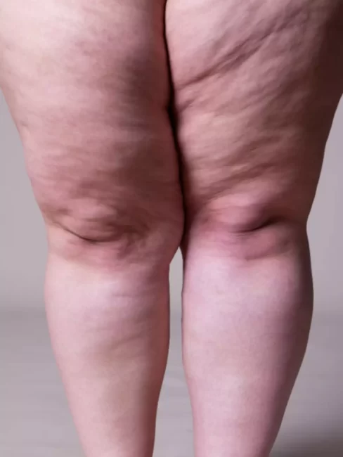 382493205-lipedema