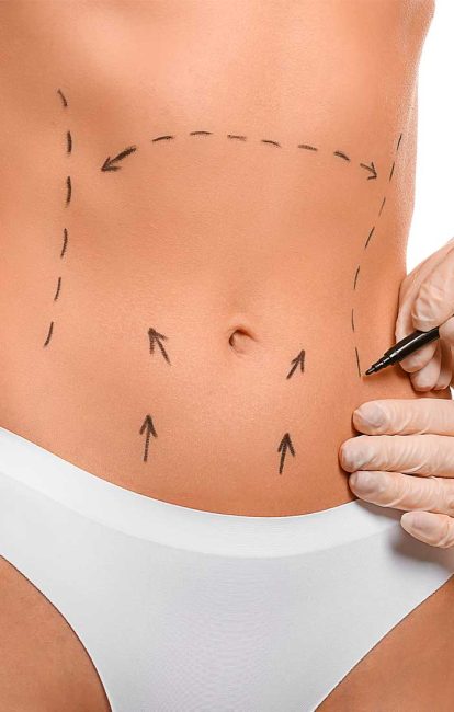 ABDOMINOPLASTIA-2