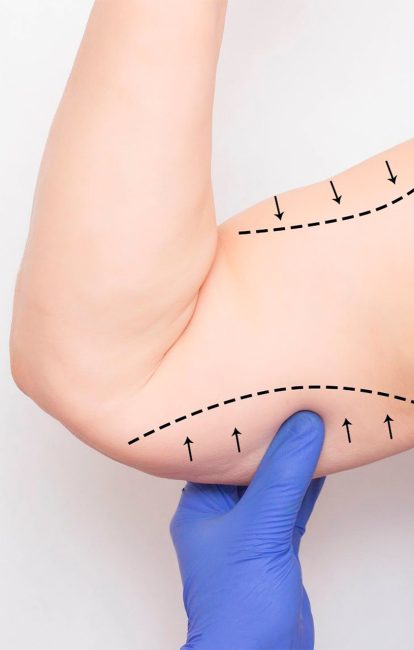 plastica-dos-bracos-2